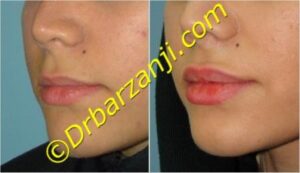 تزریق ژل در لب ها