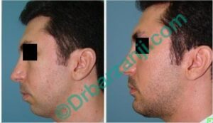 پروتز چانه دو هفته بعد از عمل