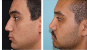 جراحی بینی، یک سال بعد از عمل