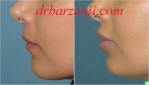 تزریق ژل جوویدرم در لب