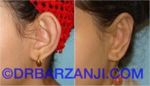 عمل جراحی پلاستیک لاله گوش