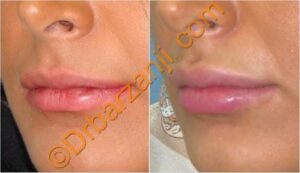 تزریق ژل جوویدرم ( ژوویدرم ) به لب یک ماه بعد