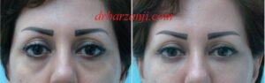 تزریق ژل بلوترو در فرورفتگی زیر چشم