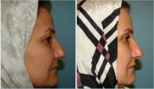 عمل جراحی پلک (بلفاروپلاستی) فوقانی