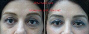 تزریق چربی زیر چشم ها