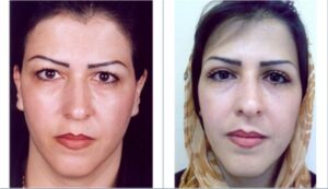 عمل جراحی پلک (بلفاروپلاستی) فوقانی