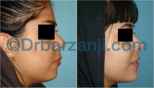 پروتز چانه و لیپوساکشن غبغب یک سال و نیم بعد