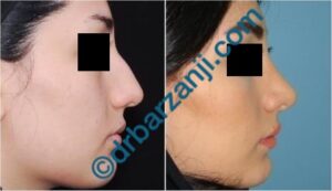 جراحی بینی یک سال و نیم بعد از عمل