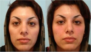 تزریق ژل در فرورفتگی پلک تحتانی-روبرو