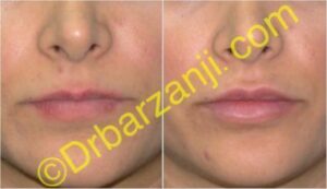 تزریق ژل جوویدرم ( ژوویدرم ) به لب یک هفته بعد