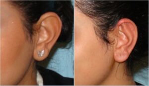 جراحی پلاستیک برجستگی لاله گوش چپ