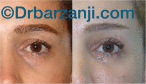 تزریق چربی زیر چشم و جراحی پلک بالا