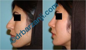 جراحی بینی یک ماه بعد از عمل