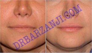 تزریق ژل رستیلن در لب