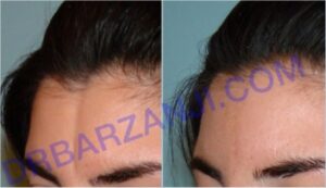 تزریق چربی در پیشانی( فرورفتگی مادرزادی)