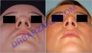 جراحی بینی، یک سال بعد از عمل