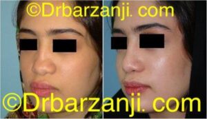 جراحی پلاستیک با پیوند غضروف دنده به بینی