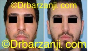 جراحی بینی دو سال بعد از عمل