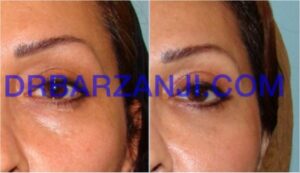 تزریق چربی در فرورفتگی زیر چشم