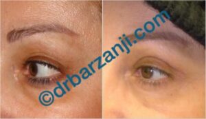جراحی پلک بالا