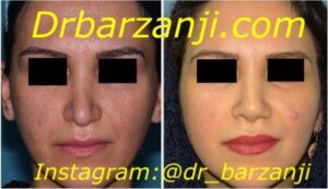 جراحی ترمیمی بینی چهار ماه بعد از عمل