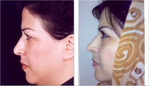 عمل جراحی پلک (بلفاروپلاستی) فوقانی