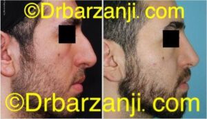 جراحی بینی دو سال بعد از عمل