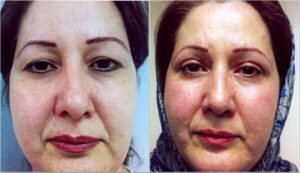 عمل جراحی پلک (بلفاروپلاستی) فوقانی