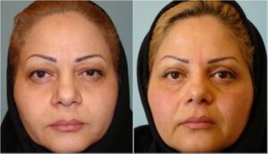 عمل جراحی پلک (بلفاروپلاستی) فوقانی