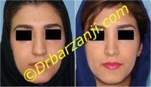 جراحی زیبایی بینی