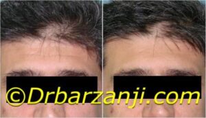 کاهش خطوط پیشانی با تزریق بوتاکس ( دیسپورت )