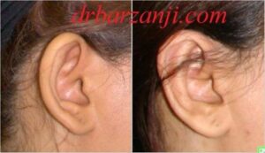 جراحی لاله گوش