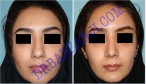 جراحی بینی ، ٣ ماه بعد از عمل