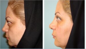 عمل جراحی پلک (بلفاروپلاستی) فوقانی