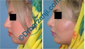 پروتز چانه و گونه سه هفته بعد از عمل