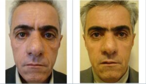 عمل جراحی پلک (بلفاروپلاستی) فوقانی