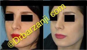 جراحی بینی سه ماه بعد از عمل