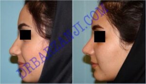 جراحی بینی ، ٣ ماه بعد از عمل