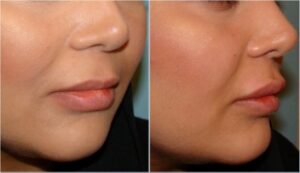 ژل جوویدرم، لب بالا