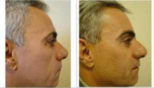 عمل جراحی پلک (بلفاروپلاستی) فوقانی