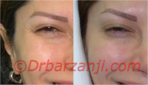 کاهش خطوط کنار چشم با تزریق بوتاکس ( دیسپورت )