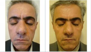 عمل جراحی پلک (بلفاروپلاستی) فوقانی