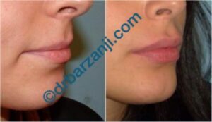 تزریق ژل لب (جوویدرم )