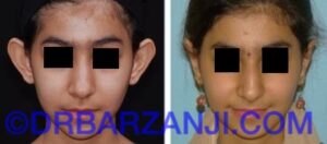 عمل جراحی لاله گوش برجسته