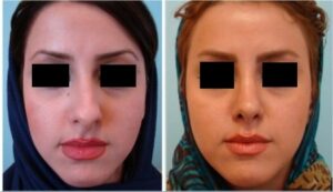 جراحی پلاستیک بینی٣ سال بعد از عمل