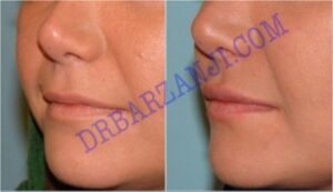 تزریق ژل رستیلن در لب