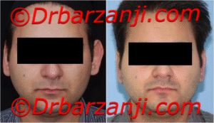 جراحی برجستگی گوش یک ماه بعد از عمل