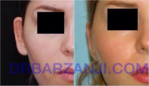 عمل جراحی لاله گوش برجسته