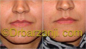 تزریق ژل در خط خنده