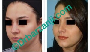 عمل جراحی پلاستیک بینی یک سال بعد